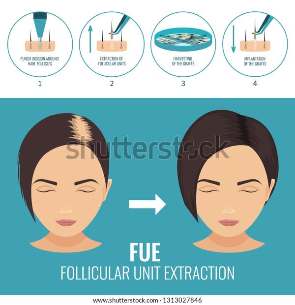 Female Hair Loss Treatment Follicular Unit 库存插图 1313027846 Shutterstock 