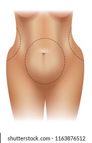 Female obese body with surgery lines colorful illustration on a white background