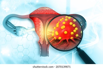 Female Reproductive System Diseases. Uterus Cancer And Endometrial Malignant Tumor As A Uterine Medical Concept. 3d Illustration