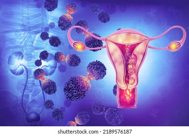 Female Reproductive System Diseases. Uterus Cancer And Endometrial Malignant Tumor As A Uterine Medical Concept. 3d Illustration