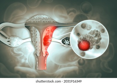 Female Reproductive System Diseases.Uterus Cancer And Endometrial Malignant Tumor As A Uterine Medical Concept.3d Illustration