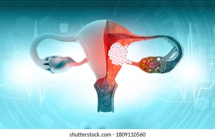 Female Uterus Cancer. 3d Illustration		