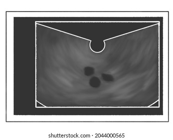 Fetal Ultrasound Scan Of Fetal Sac (triplets)