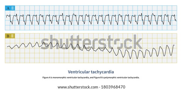 Figure Monomorphic Ventricular Tachycardia Figure B Stock Illustration 1803968470