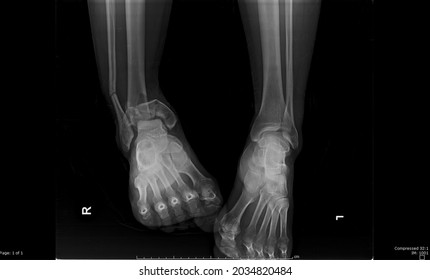  Film Fracture Ankle Right Leg
Broken Ankle  Surgery