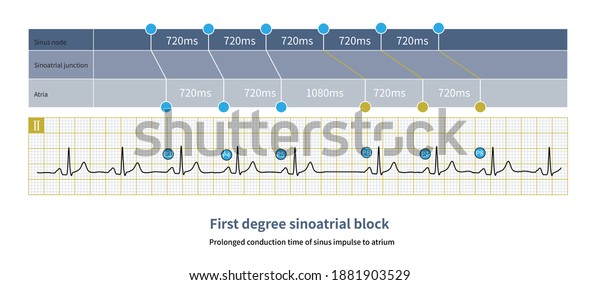 First Degree Sinoatrial Block Ecg Can Stock Illustration 1881903529