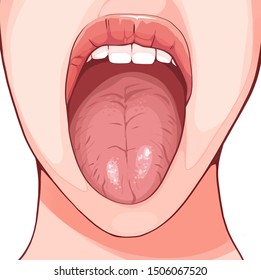 Fissured tongue is a benign condition characterized by fissures in the dorsum of the tongue.