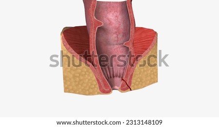 A fistula is an abnormal connection between two parts inside of the body.3D rendering