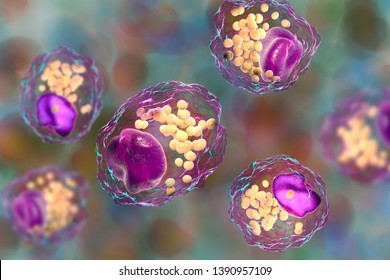 Foam cell, macrophage cells that contain lipid droplets and are components of atherosclerotic plaque, 3D illustration