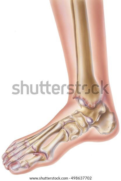 Foot Ankle Rheumatoid Arthritis Rheumatoid Arthritis Stock