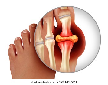 Foot gout and painful feet arthritis disease as toes close up with a human toe as a hyperuricemia symbol of diagnosing chronic pain isolated on a white background as a 3D illustration style.