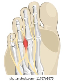 Foot Nerves Inflammation, Morton Neuroma