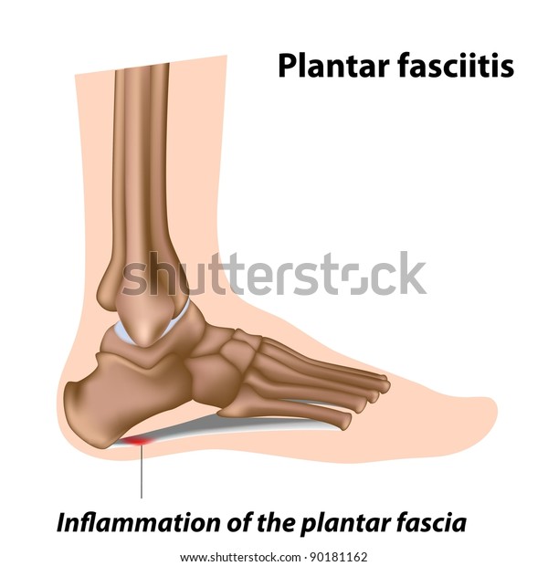 足部问题 足底筋膜炎库存插图