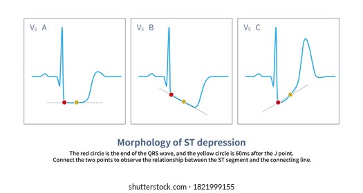 The Form Of ST Segment Depression Can Be Divided Into Three Types: A Is Horizontal, B Is Downward Slope And C Is Upward Slope. 