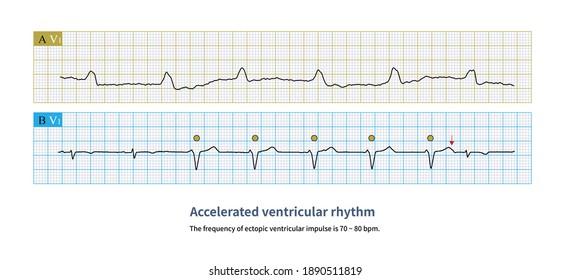 30 Ventricular Escape Images, Stock Photos & Vectors | Shutterstock