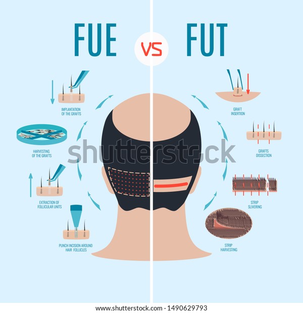 Fueとfut濾胞単位抽出対濾胞単位移植 毛髪移植の手順とその段階のタイプ 男性脱毛症治療 医療インフォグラフィックス のイラスト素材