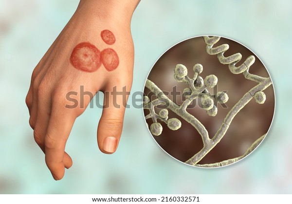 Fungal infection on a human hand. Ringworm,\
tinea manuum and close-up view of dermatophyte fungi Trichophyton\
mentagrophytes, 3D\
illustration