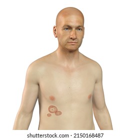 Fungal Infection On A Man's Body. Tinea Corporis, 3D Illustration