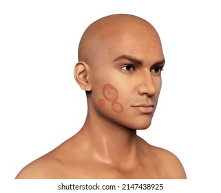 Fungal Infection On A Man's Face, 3D Illustration. Tinea Faciei, Caused By Fungi Microsporum Canis, Trichophyton Rubrum, T. Mentagrophytes And Other