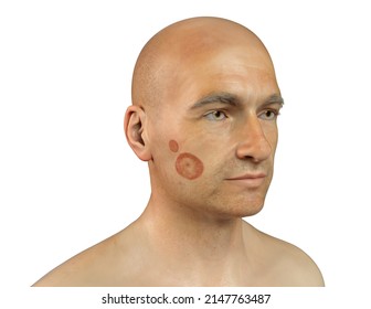 Fungal Infection On A Man's Face, 3D Illustration. Tinea Faciei, Caused By Fungi Microsporum Canis, Trichophyton Rubrum, T. Mentagrophytes And Other