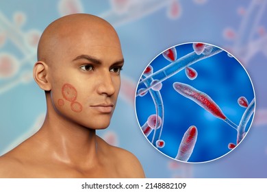 Fungal Infection On A Man's Face, 3D Illustration Of A Man With Tinea Faciei And Close-up View Of Fungi Trichophyton Rubrum