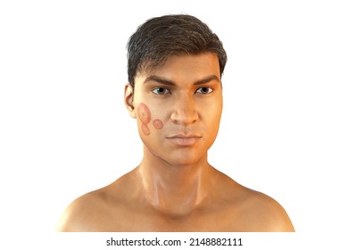 Fungal Infection On A Man's Face, 3D Illustration. Tinea Faciei, Caused By Fungi Microsporum Canis, Trichophyton Rubrum, T. Mentagrophytes And Other