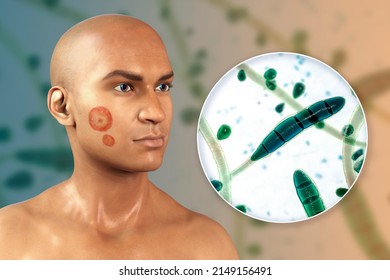 Fungal Infection On A Man's Face, 3D Illustration Of A Man With Tinea Faciei And Close-up View Of Fungi Trichophyton Rubrum