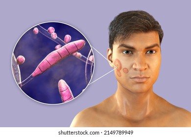 Fungal Infection On A Man's Face, 3D Illustration Of A Man With Tinea Faciei And Close-up View Of Fungi Trichophyton Rubrum