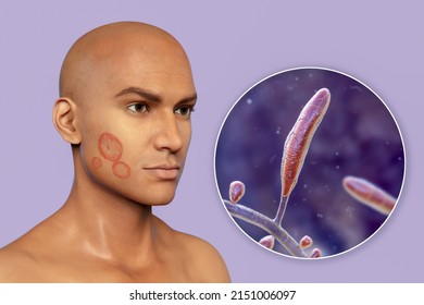 Fungal Infection On A Man's Face, 3D Illustration Of A Man With Tinea Faciei And Close-up View Of Fungi Trichophyton Rubrum