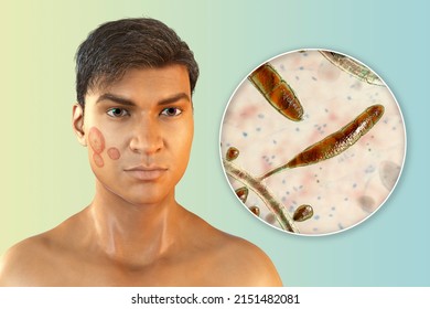 Fungal Infection On A Man's Face, 3D Illustration Of A Man With Tinea Faciei And Close-up View Of Fungi Trichophyton Rubrum