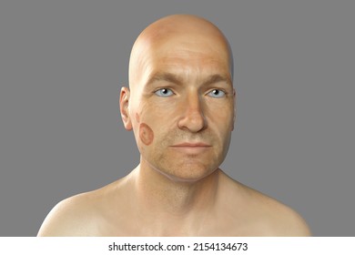 Fungal Infection On A Man's Face, 3D Illustration. Tinea Faciei, Caused By Fungi Microsporum Canis, Trichophyton Rubrum, T. Mentagrophytes And Other