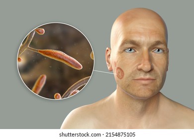 Fungal Infection On A Man's Face, 3D Illustration Of A Man With Tinea Faciei And Close-up View Of Fungi Trichophyton Rubrum