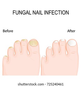 Fungal Nail Infection Onychomycosis Tinea Unguium: Stockvector ...