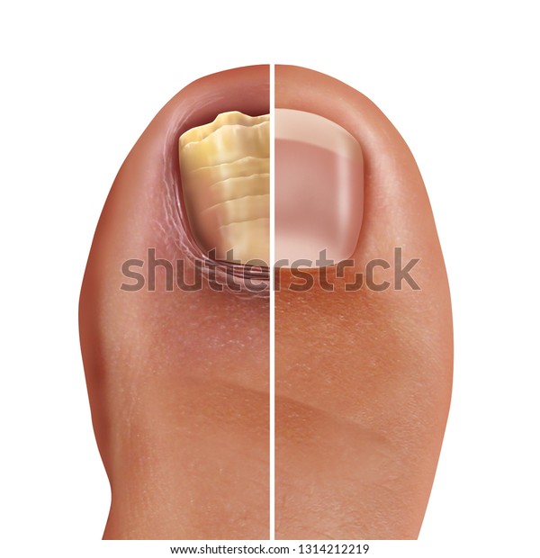 3dイラストスタイルで 感染した足の爪やつま先の爪に 害のある健康な人間の解剖学を持つ 真菌性の爪感染症や爪菌性の爪虫 爪甲虫 爪牙類の爪 のイラスト素材