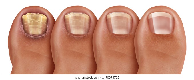 Nail Fungus Images Stock Photos Vectors Shutterstock