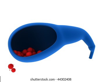 Gall Bladder Stones