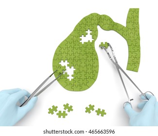 Gallbladder Puzzle Concept: Hands Of Surgeon With Surgical Instruments Perform Gall Bladder Surgery As A Result Of Cholelithiasis, Cholecystitis, Cholecystectomy, Biliary Dyskinesia. 3d Rendering