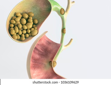 Gallstones In Gallbladder And Bile Duct - 3D Rendering