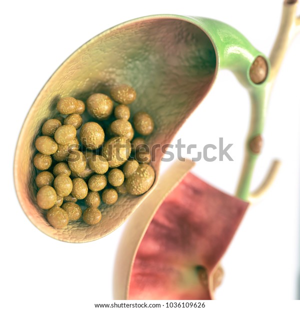 Gallstones Gallbladder Bile Duct 3d Rendering Stock Illustration 1036109626