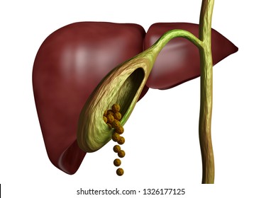 Gallstones Gallbladder Bile Duct Isolated White Stock Illustration ...