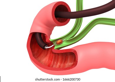 Gallstones Removing The Gallbladder. 3d Illustration