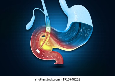 Gallstones Removing The Gallbladder. 3d Illustration