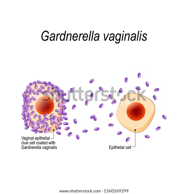 ガードネレラ ヴァギナリス 性器感染 細菌で覆われた膣上皮細胞 細菌性膣疾患 性感染 生物学 科学 医学用のイラスト のイラスト素材