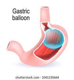 Gastric balloon. inflatable medical device that is temporarily placed into the stomach to reduce weight. Human anatomy. diagram for medical use
