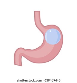 Gastric Balloon Stomach. 