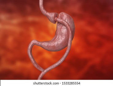 Gastric bypass is a type of bariatric surgery that consists of reducing the stomach and altering the bowel, leading to a marked loss of body weight. 3D rendering