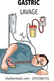 Gastric Lavage With A Gastric Tube	