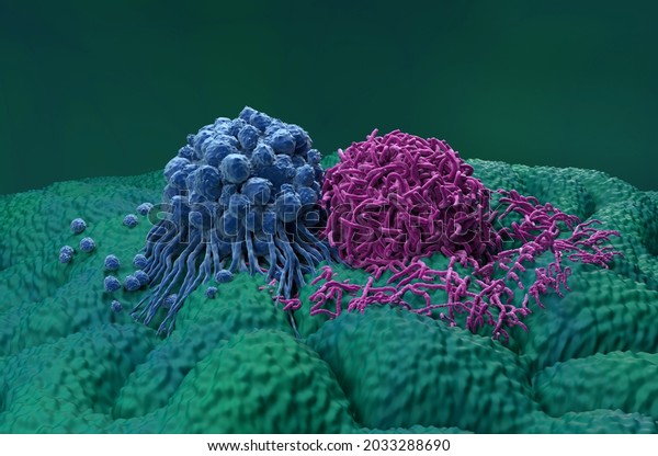Gastric\
stomach cancer cells closeup view 3d\
illustration
