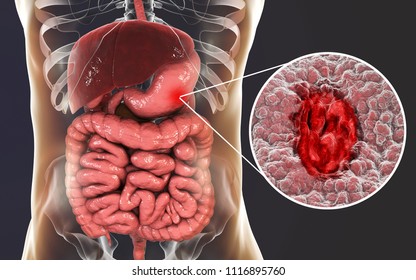 Gastric Ulcer. Mucosa Of Stomach With Ulcer And Anatomy Of Human Digestive System. 3D Illustration