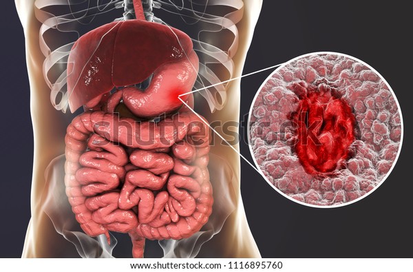 Gastric ulcer. Mucosa of stomach\
with ulcer and anatomy of human digestive system. 3D\
illustration
